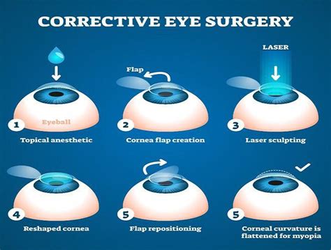 laser eye correction price.